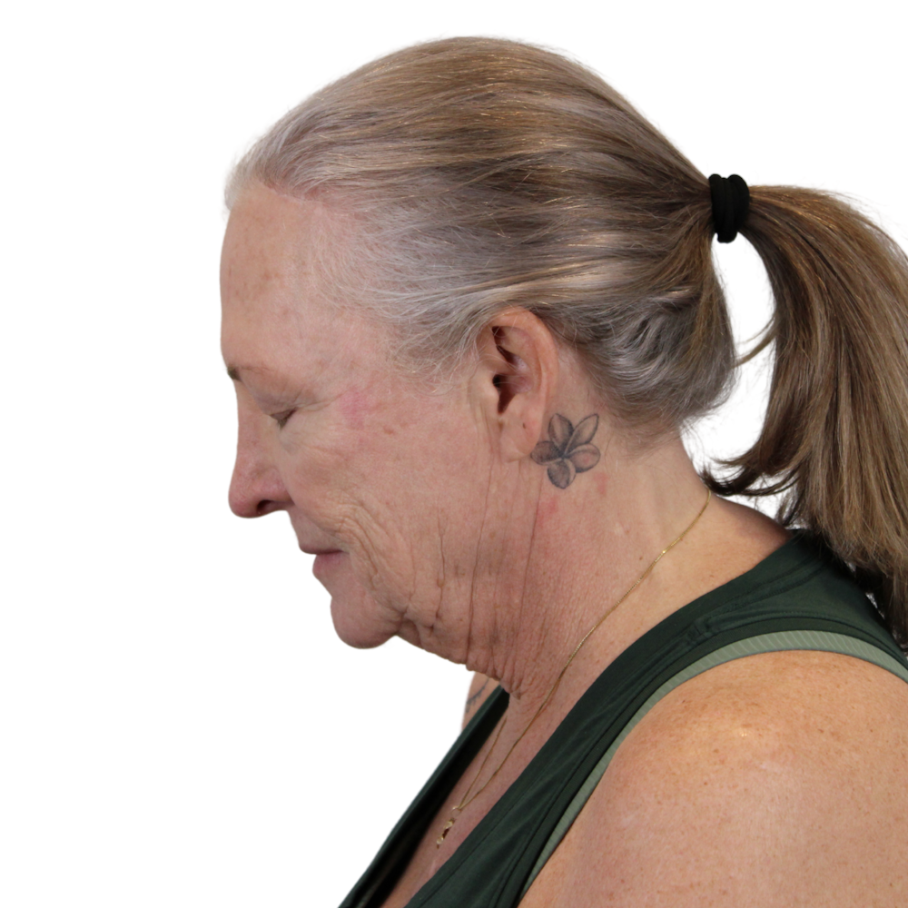 Deep Plane Facelift Before & After Gallery - Patient 226378 - Image 13