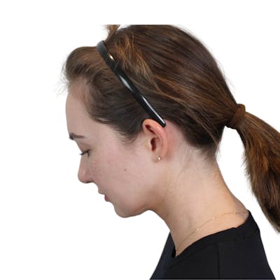 Deep Neck Lift Before & After Gallery - Patient 134891 - Image 14