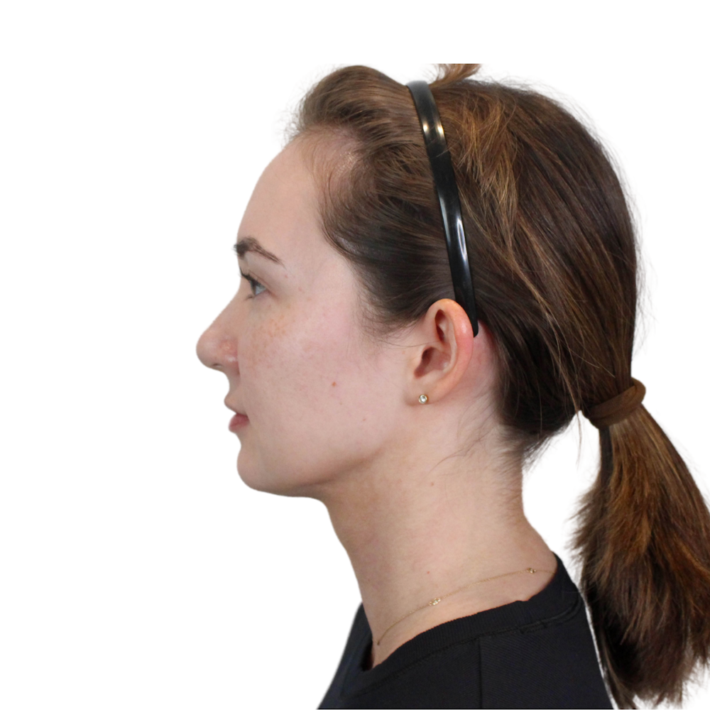 Deep Neck Lift Before & After Gallery - Patient 134891 - Image 12