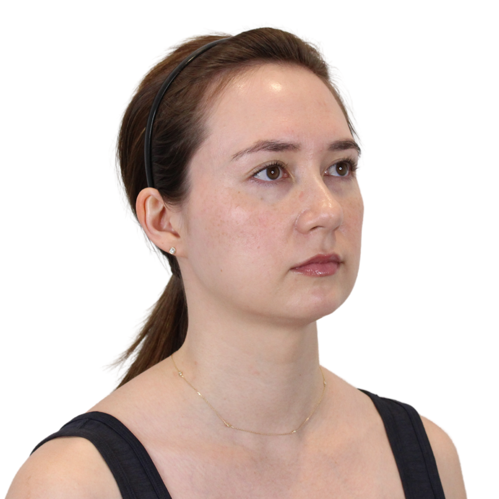 Deep Neck Lift Before & After Gallery - Patient 134891 - Image 3