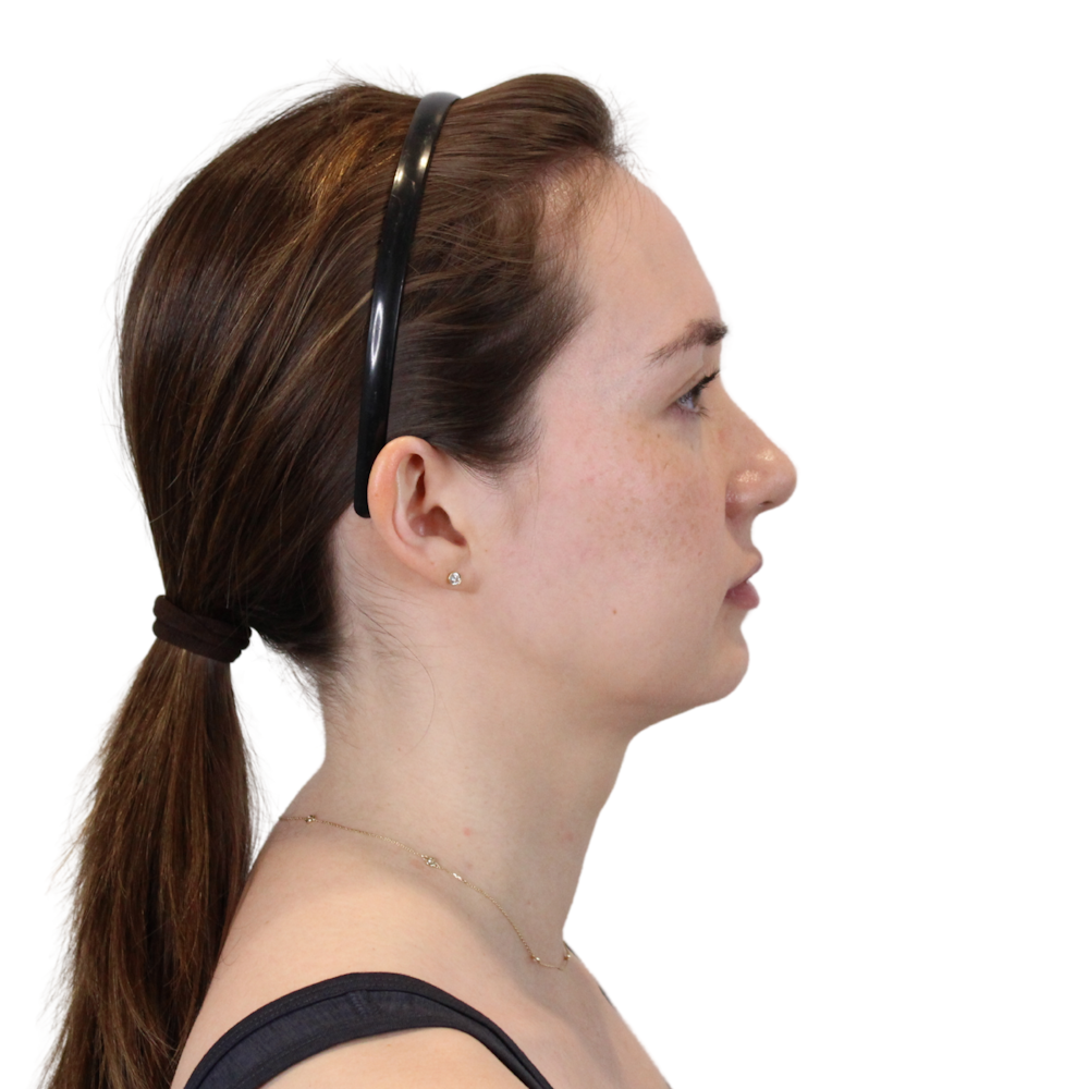 Deep Neck Lift Before & After Gallery - Patient 134891 - Image 5