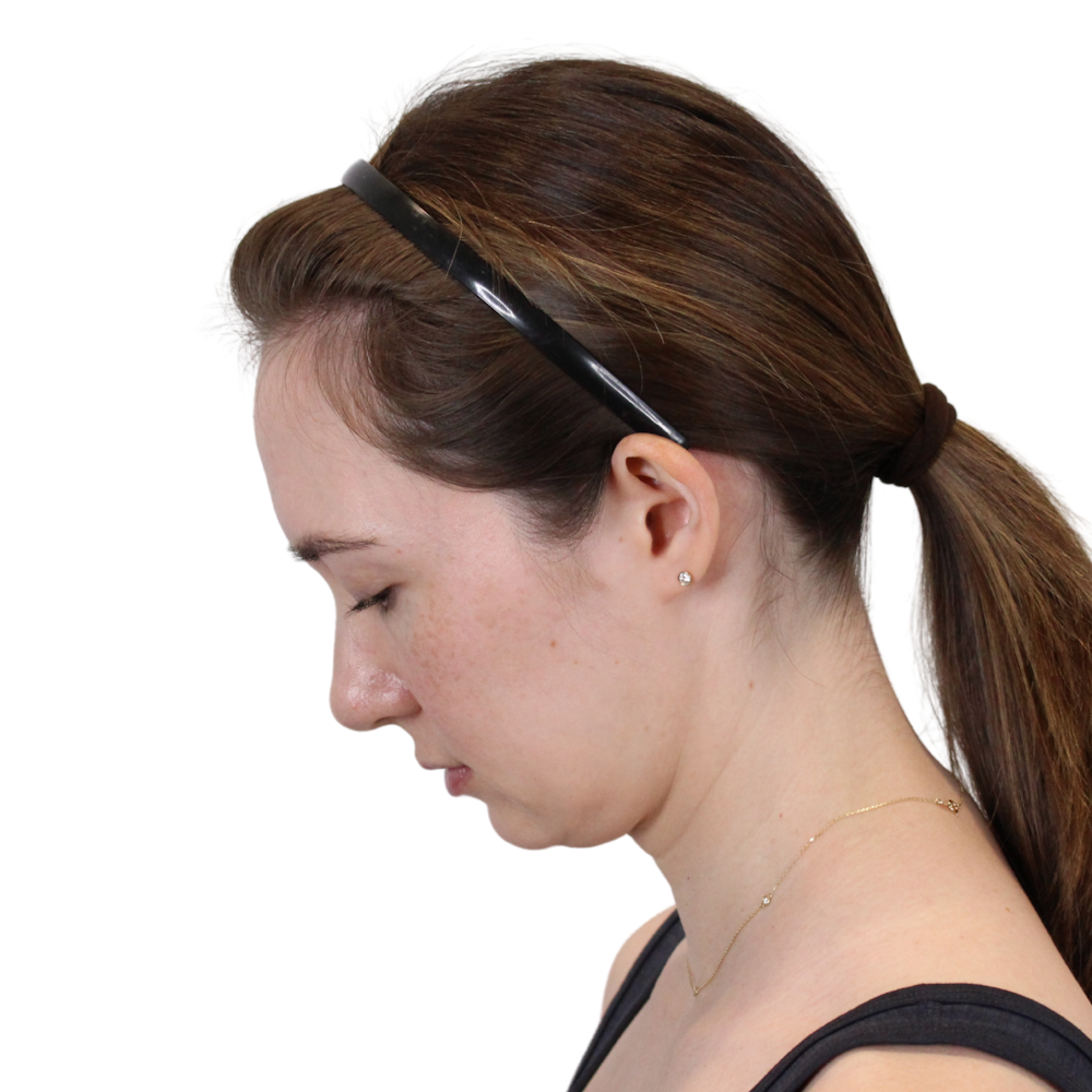 Deep Neck Lift Before & After Gallery - Patient 134891 - Image 13