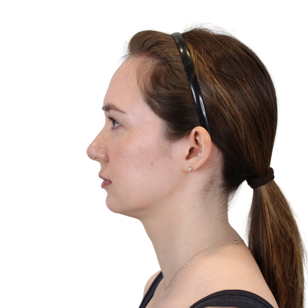 Deep Neck Lift Before & After Gallery - Patient 134891 - Image 11