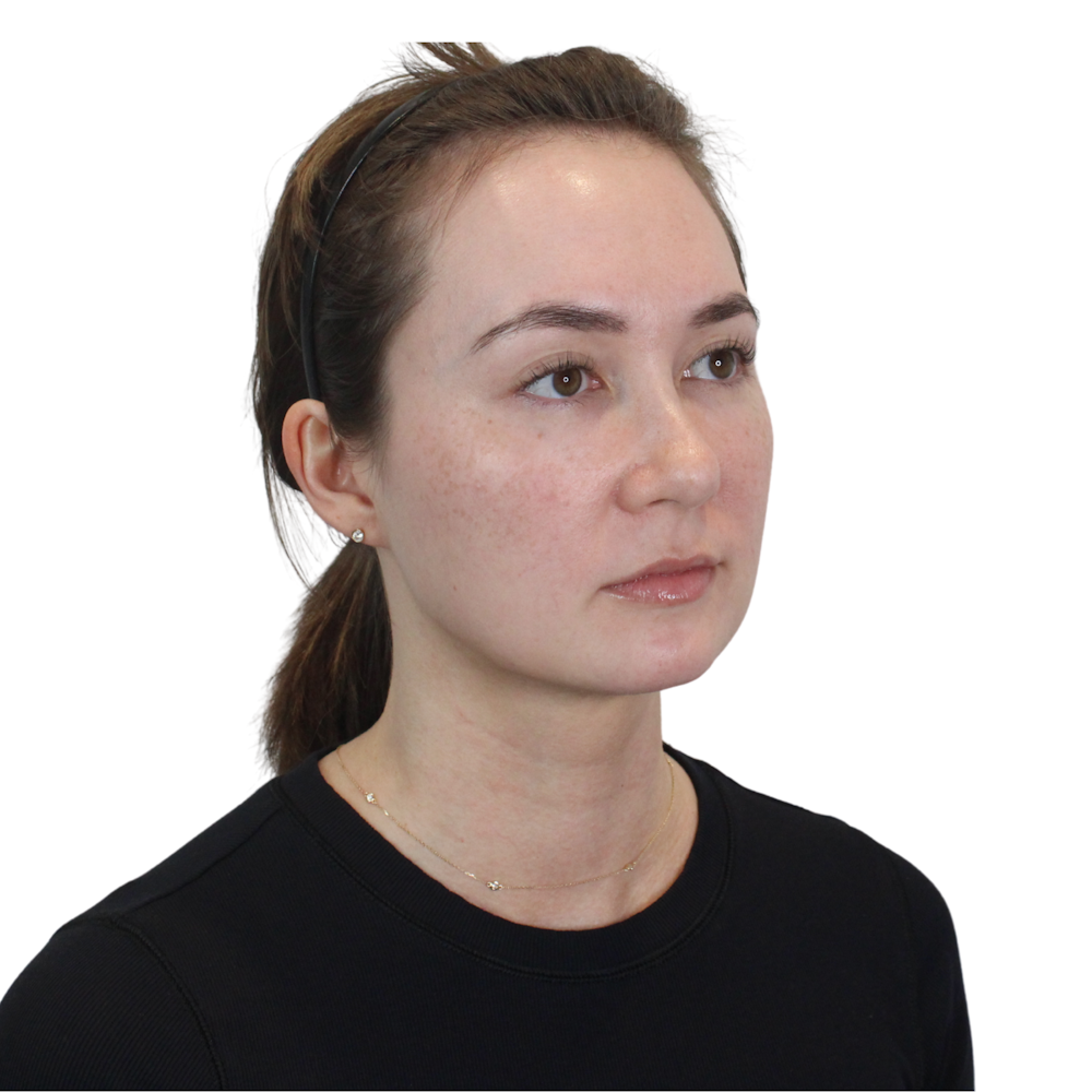 Deep Neck Lift Before & After Gallery - Patient 134891 - Image 4