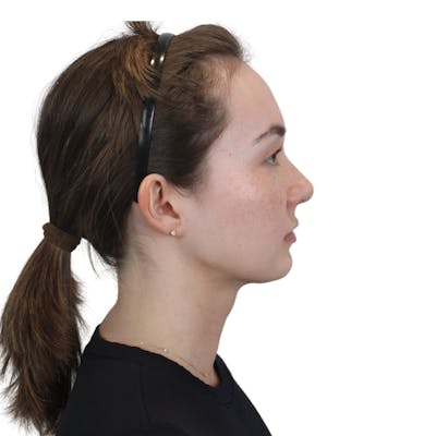 Deep Neck Lift Before & After Gallery - Patient 134891 - Image 6