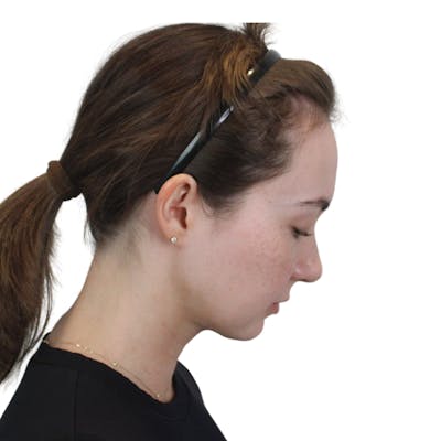Deep Neck Lift Before & After Gallery - Patient 134891 - Image 8