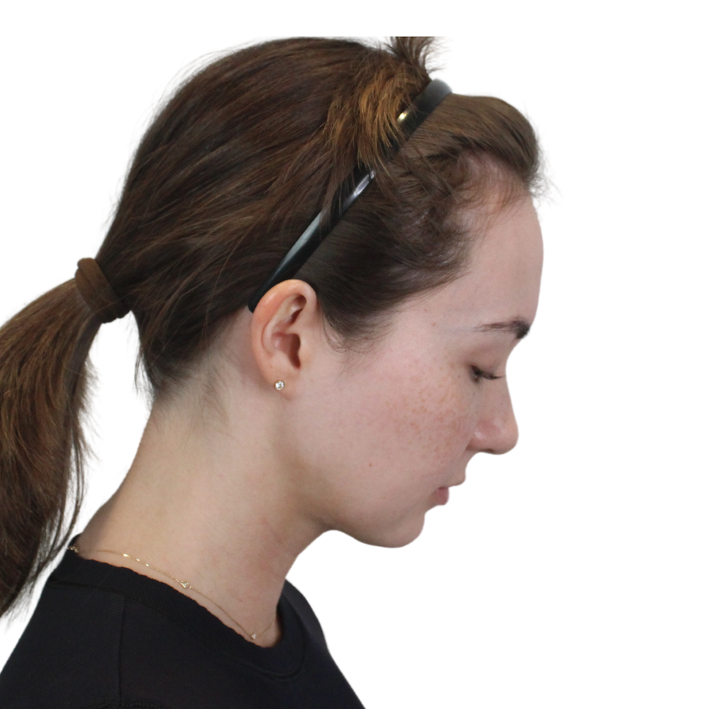 Deep Neck Lift Before & After Gallery - Patient 134891 - Image 8