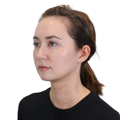 Deep Neck Lift Before & After Gallery - Patient 134891 - Image 10