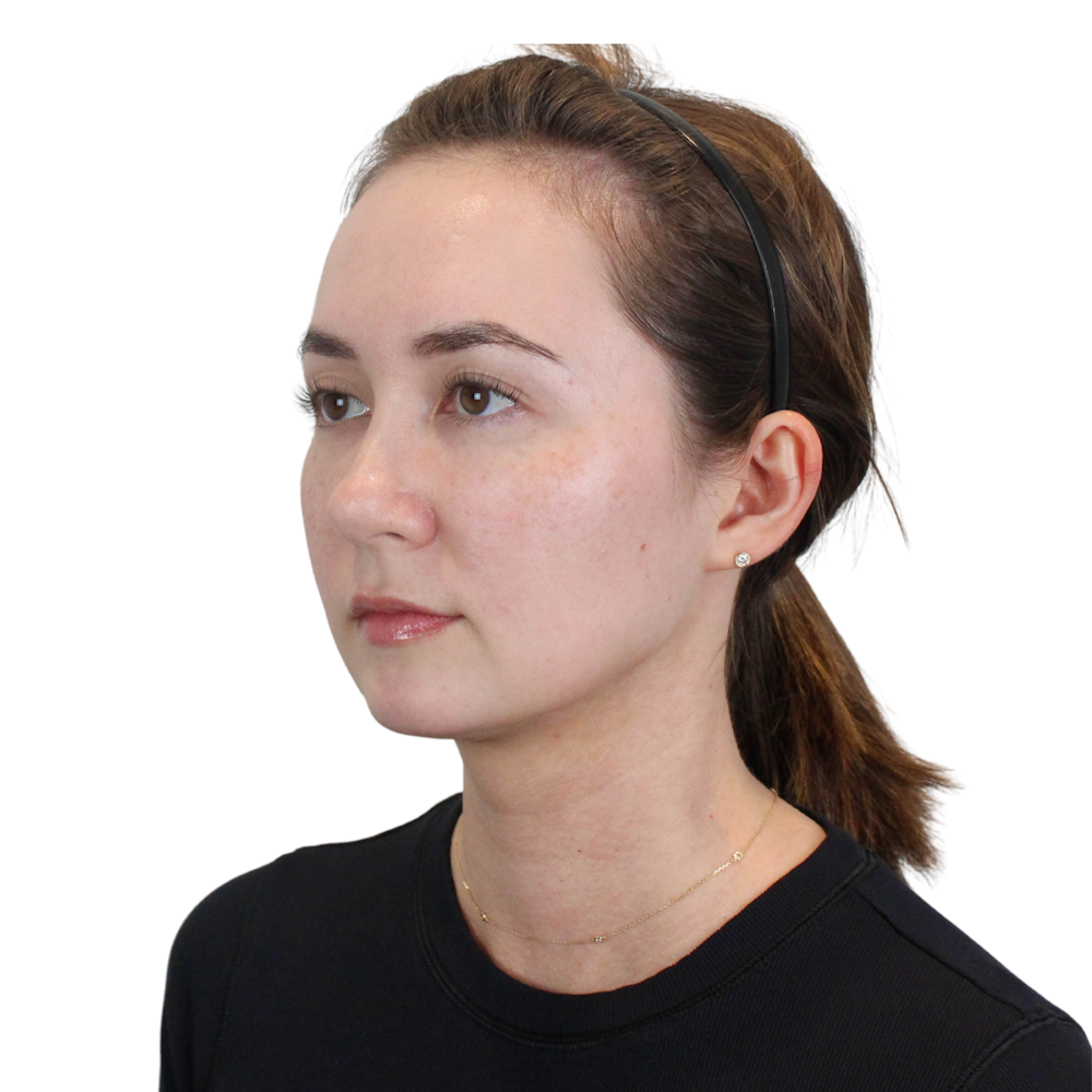 Deep Neck Lift Before & After Gallery - Patient 134891 - Image 10