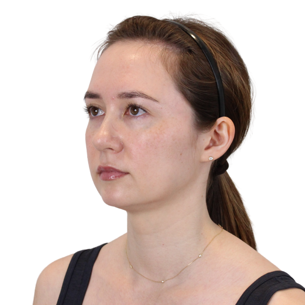Deep Neck Lift Before & After Gallery - Patient 134891 - Image 9