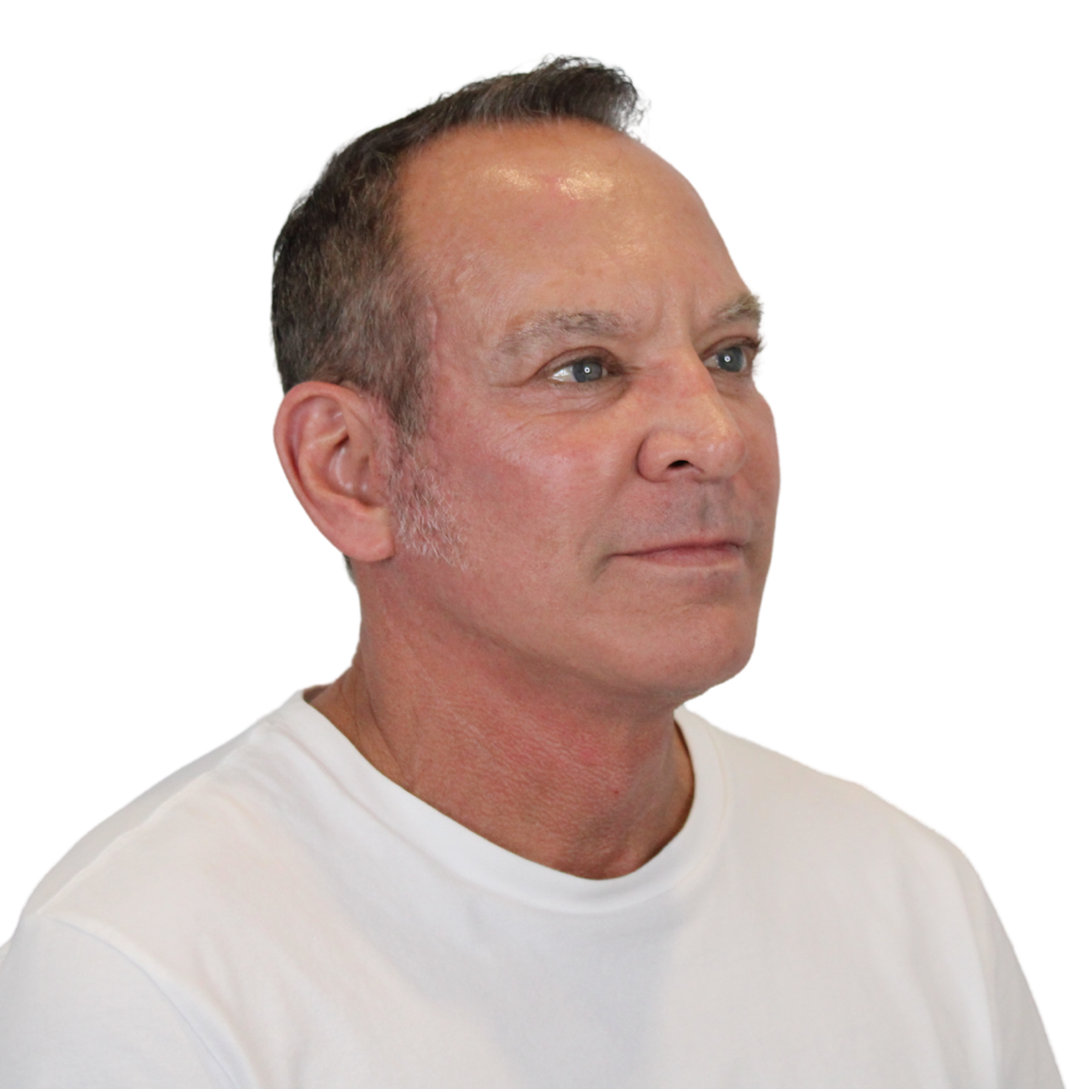 Deep Neck Lift Before & After Gallery - Patient 100925 - Image 4