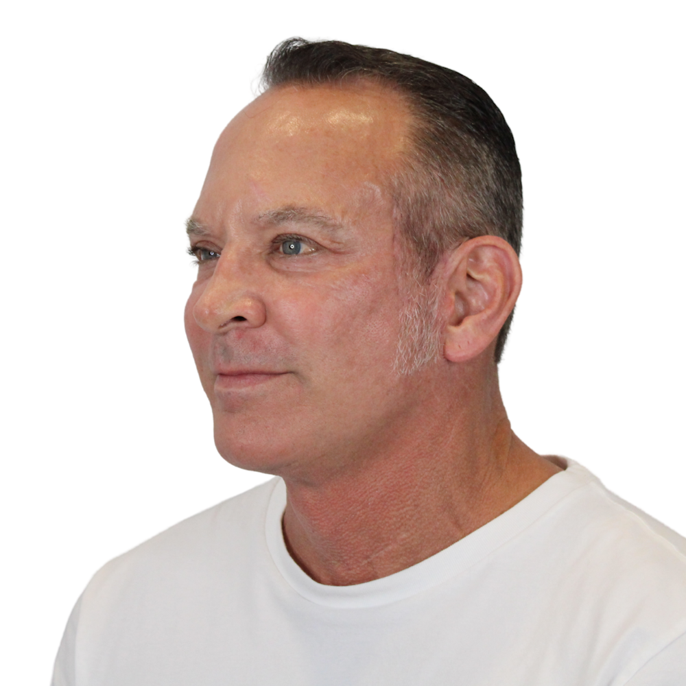 Deep Neck Lift Before & After Gallery - Patient 100925 - Image 6