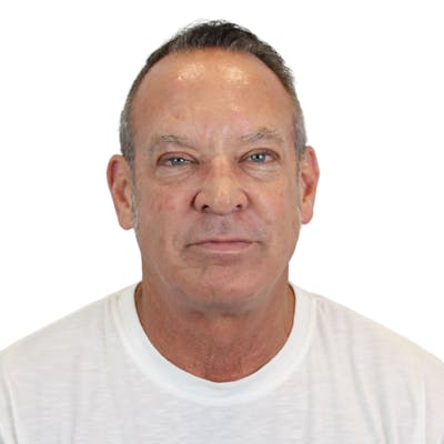 Deep Plane Facelift Before & After Gallery - Patient 220539 - Image 1