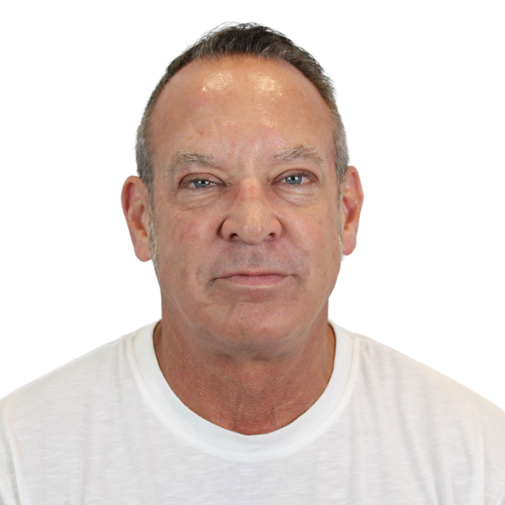 Deep Neck Lift Before & After Gallery - Patient 100925 - Image 1