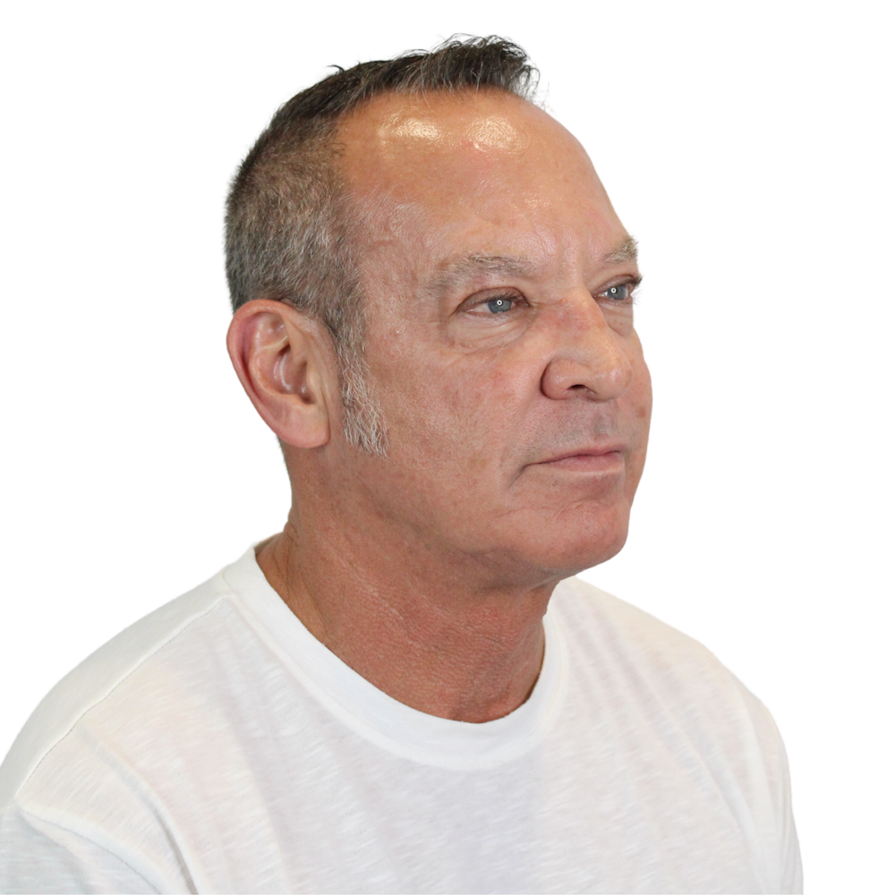 Deep Neck Lift Before & After Gallery - Patient 100925 - Image 3
