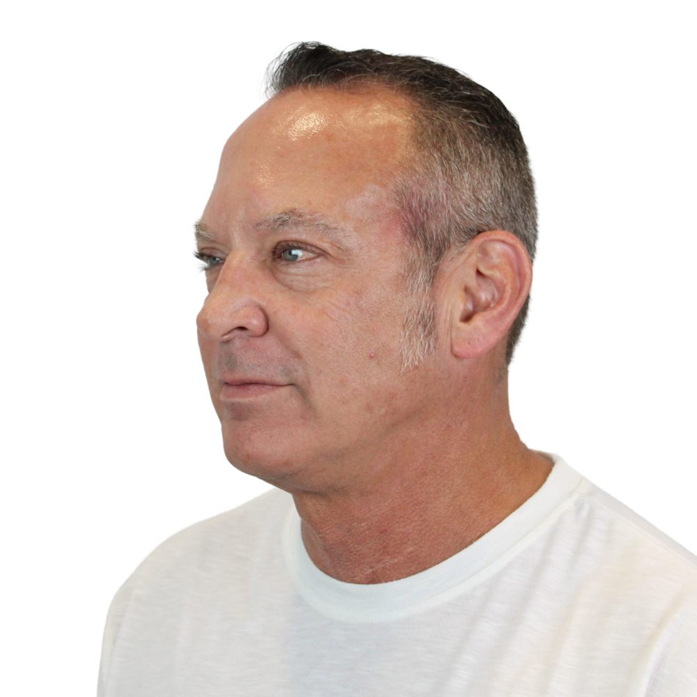 Deep Neck Lift Before & After Gallery - Patient 100925 - Image 5