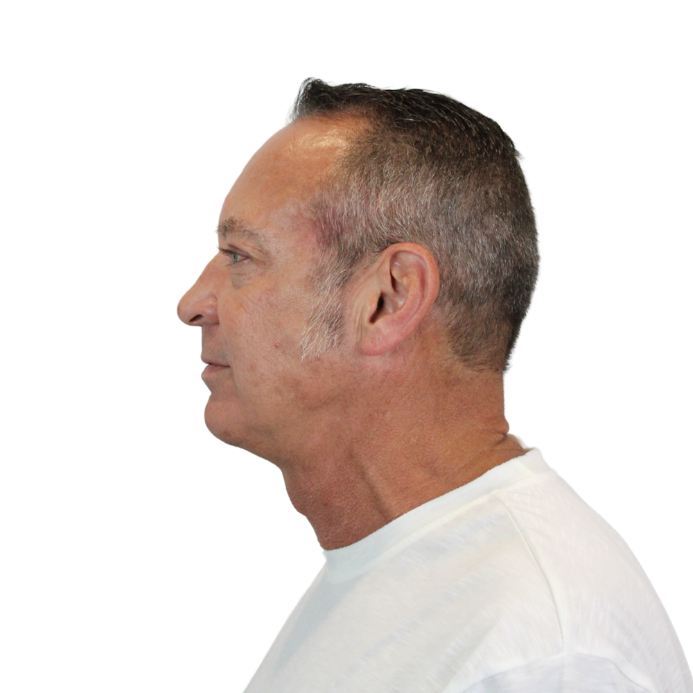 Deep Neck Lift Before & After Gallery - Patient 100925 - Image 7