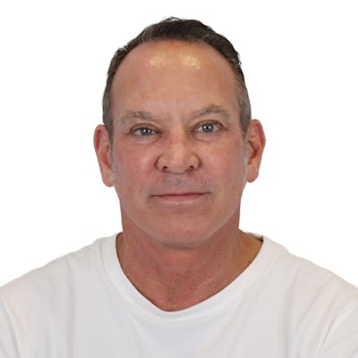 Deep Neck Lift Before & After Gallery - Patient 100925 - Image 2
