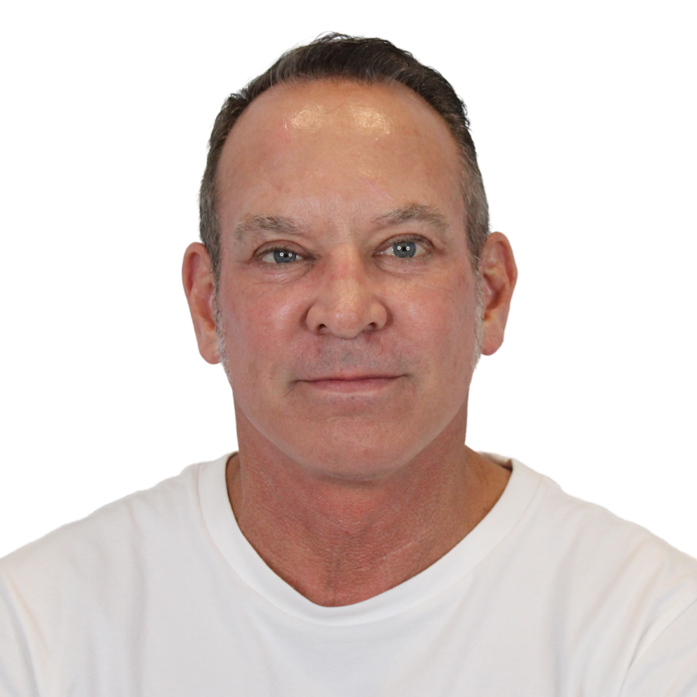 Deep Neck Lift Before & After Gallery - Patient 100925 - Image 2