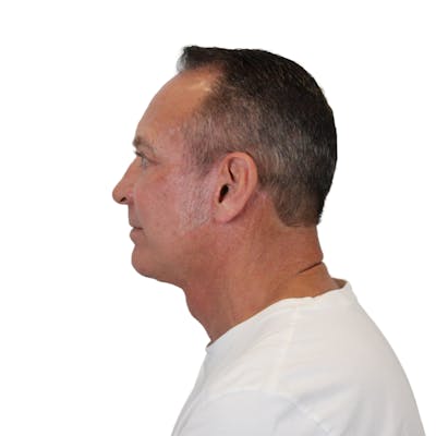 Deep Neck Lift Before & After Gallery - Patient 100925 - Image 8