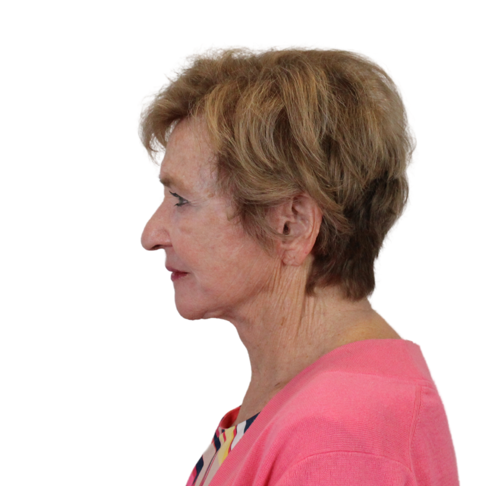 Deep Neck Lift Before & After Gallery - Patient 119730 - Image 8