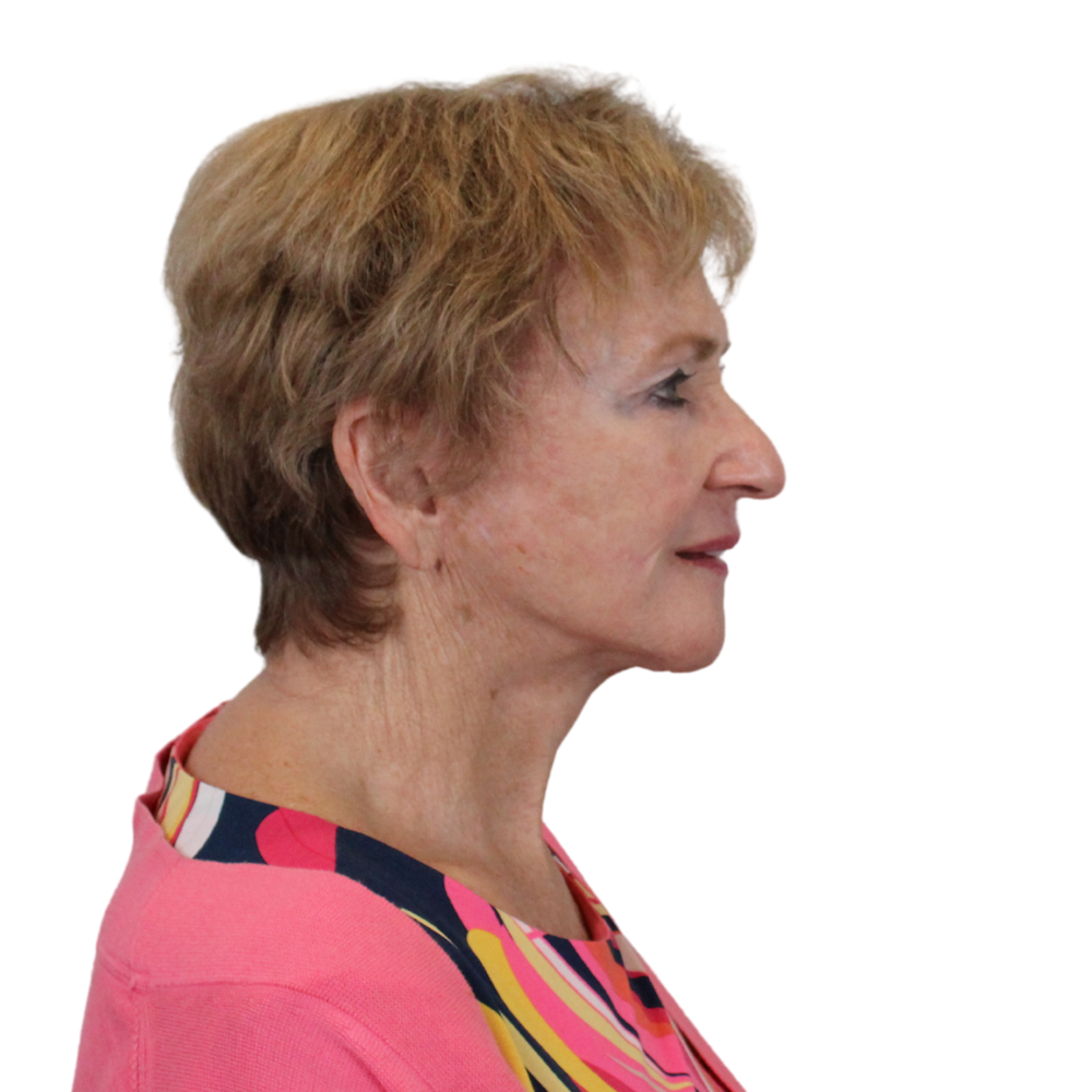 Deep Neck Lift Before & After Gallery - Patient 119730 - Image 10