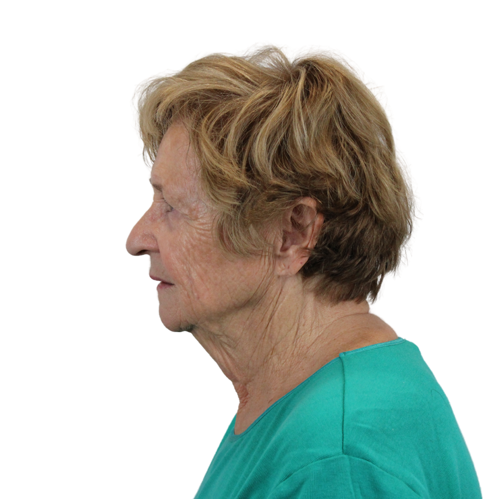 Deep Neck Lift Before & After Gallery - Patient 119730 - Image 7