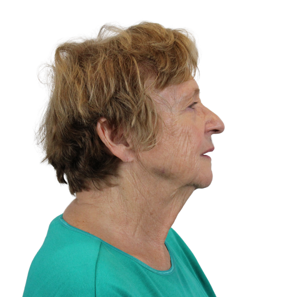 Deep Neck Lift Before & After Gallery - Patient 119730 - Image 9