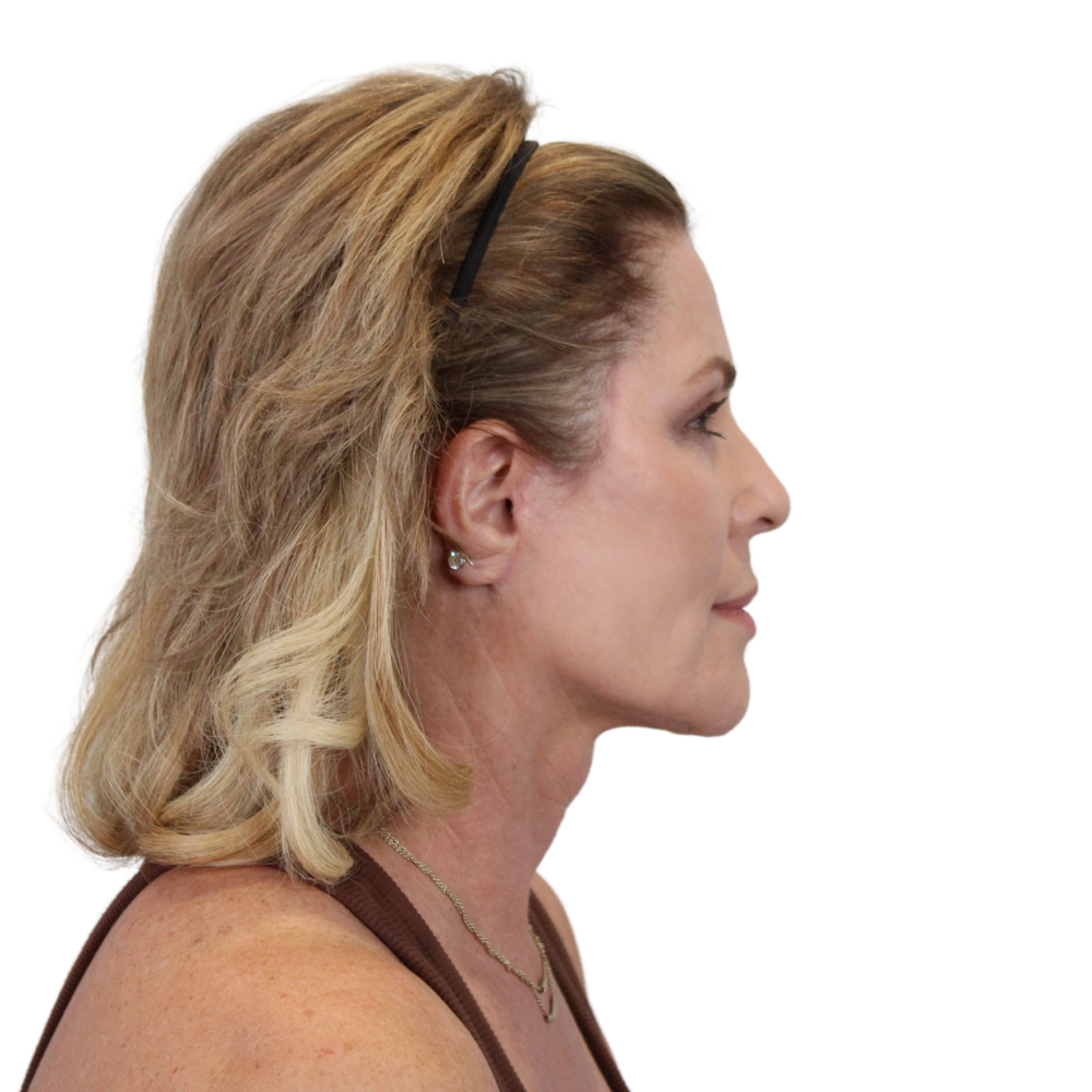 Deep Plane Facelift Before & After Gallery - Patient 303139 - Image 12