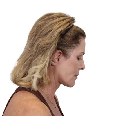 Deep Plane Facelift Before & After Gallery - Patient 303139 - Image 10