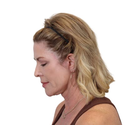 Deep Plane Facelift Before & After Gallery - Patient 303139 - Image 8