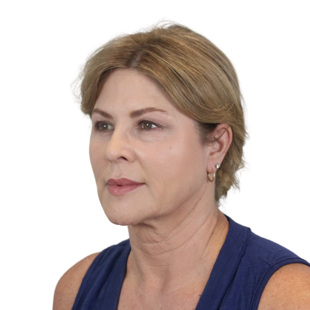 Deep Plane Facelift Before & After Gallery - Patient 303139 - Image 5