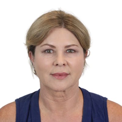 Deep Plane Facelift Before & After Gallery - Patient 303139 - Image 1