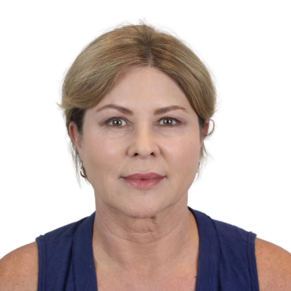Deep Plane Facelift Before & After Gallery - Patient 303139 - Image 1