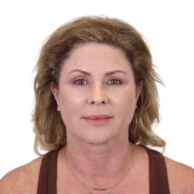 Deep Plane Facelift Before & After Gallery - Patient 303139 - Image 2