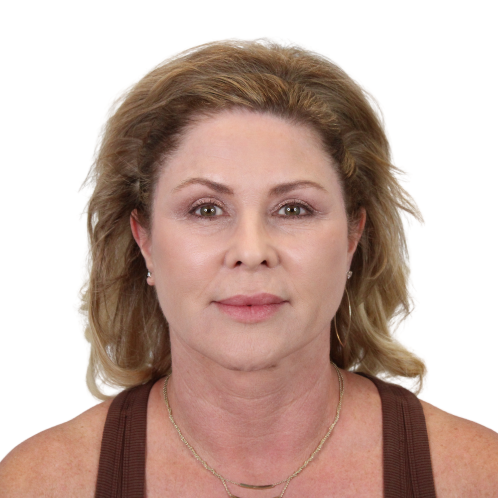 Deep Plane Facelift Before & After Gallery - Patient 303139 - Image 2