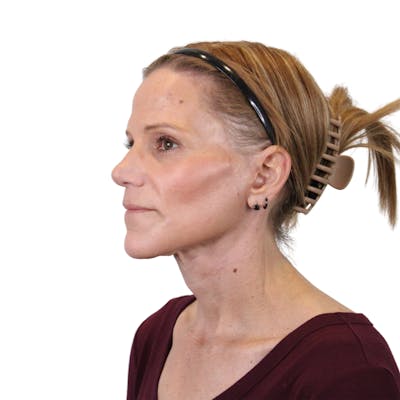 Deep Plane Facelift Before & After Gallery - Patient 131086 - Image 6