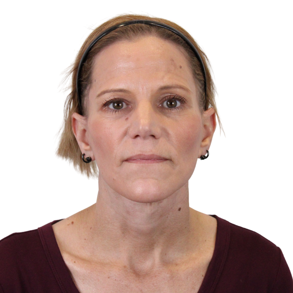 Deep Plane Facelift Before & After Gallery - Patient 131086 - Image 2