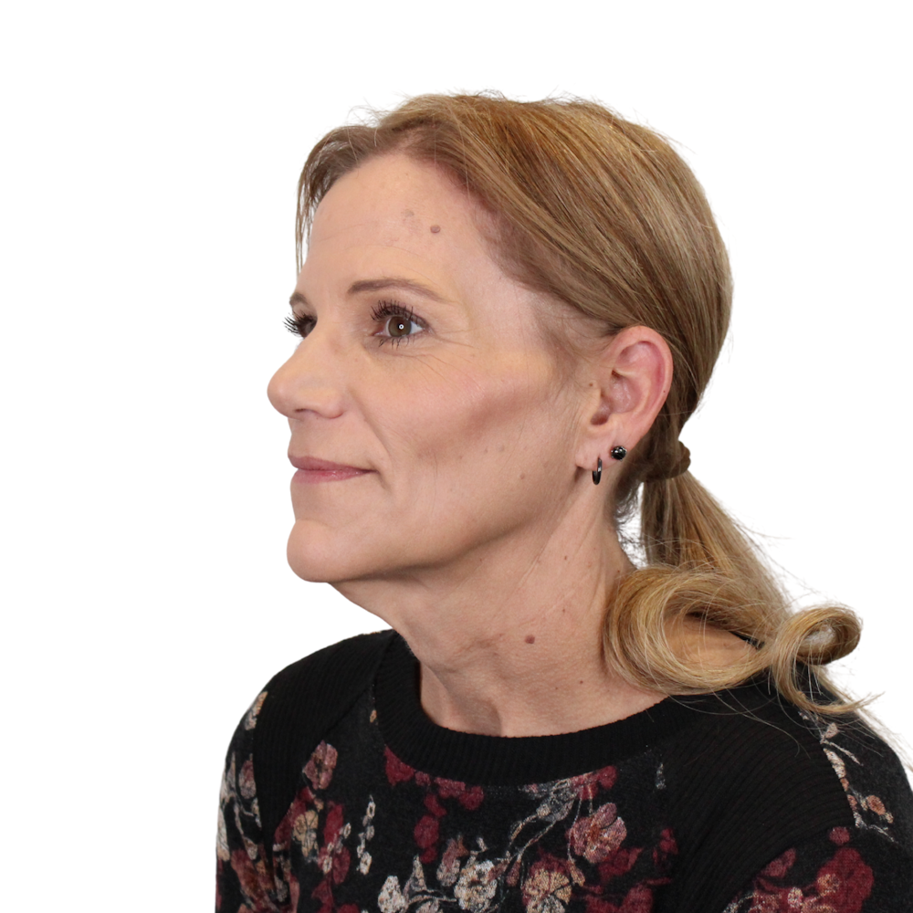 Deep Plane Facelift Before & After Gallery - Patient 131086 - Image 5