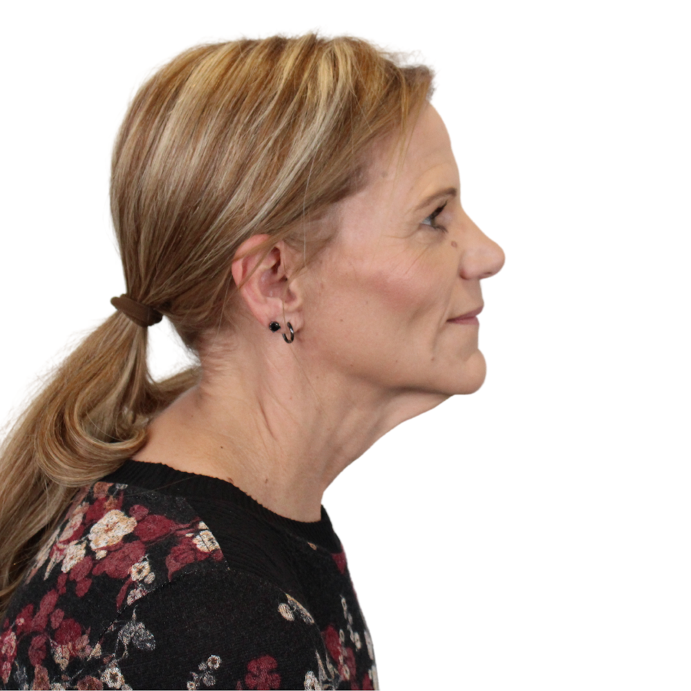 Deep Plane Facelift Before & After Gallery - Patient 131086 - Image 11