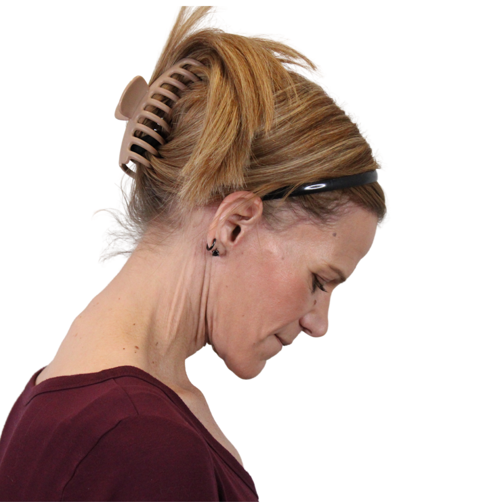 Deep Plane Facelift Before & After Gallery - Patient 131086 - Image 8