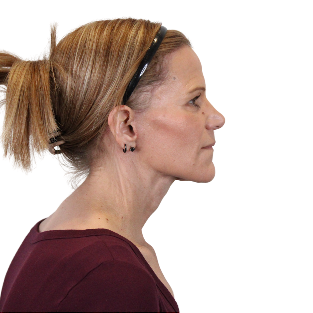 Deep Plane Facelift Before & After Gallery - Patient 131086 - Image 12