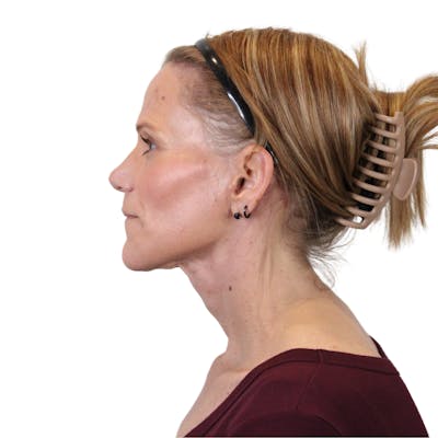 Deep Plane Facelift Before & After Gallery - Patient 131086 - Image 14