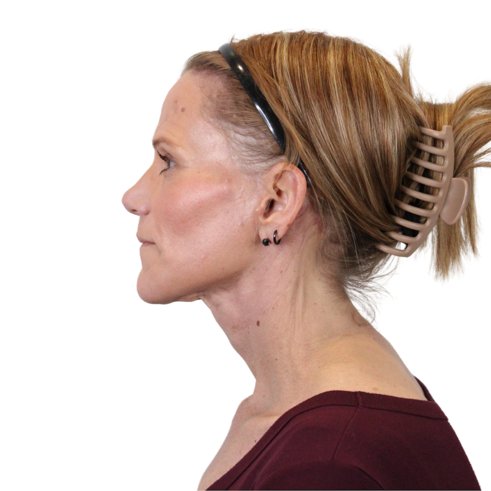 Deep Plane Facelift Before & After Gallery - Patient 131086 - Image 14