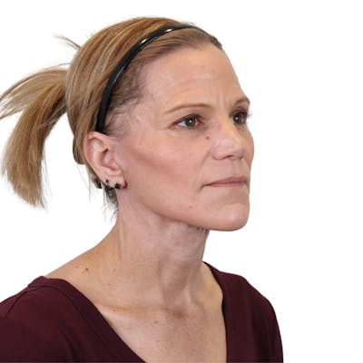 Deep Plane Facelift Before & After Gallery - Patient 131086 - Image 4