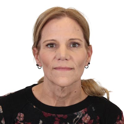 Deep Plane Facelift Before & After Gallery - Patient 131086 - Image 1