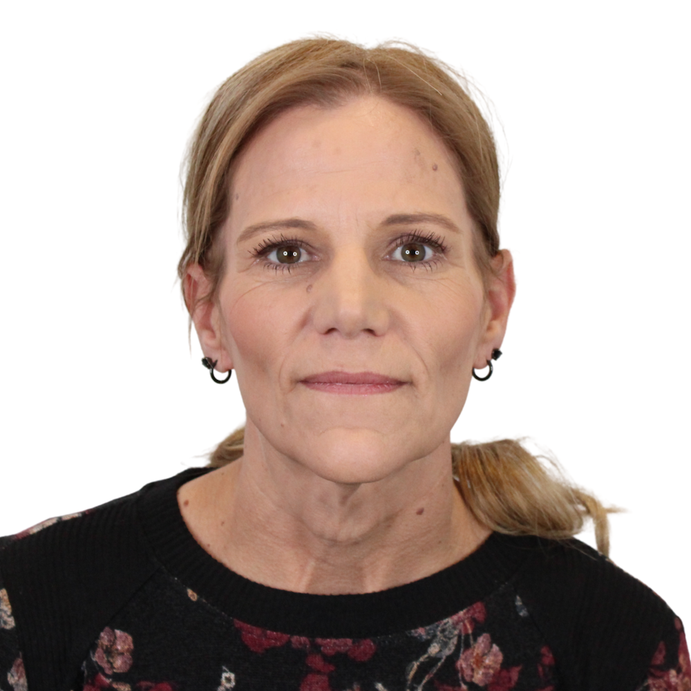 Deep Plane Facelift Before & After Gallery - Patient 131086 - Image 1