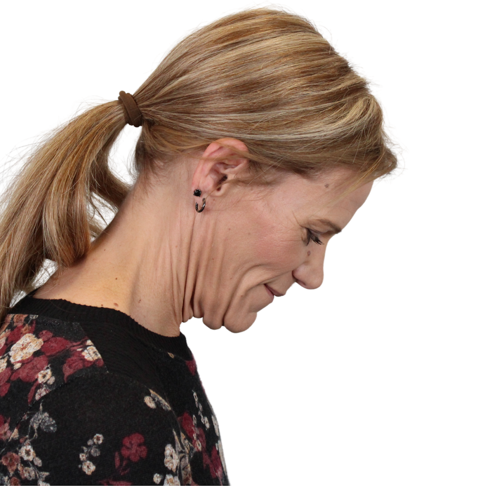 Deep Plane Facelift Before & After Gallery - Patient 131086 - Image 7