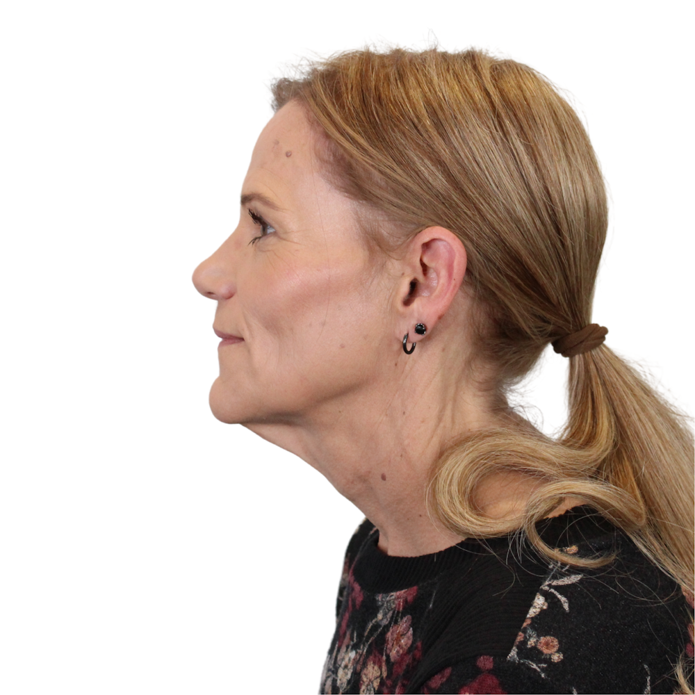 Deep Plane Facelift Before & After Gallery - Patient 131086 - Image 13
