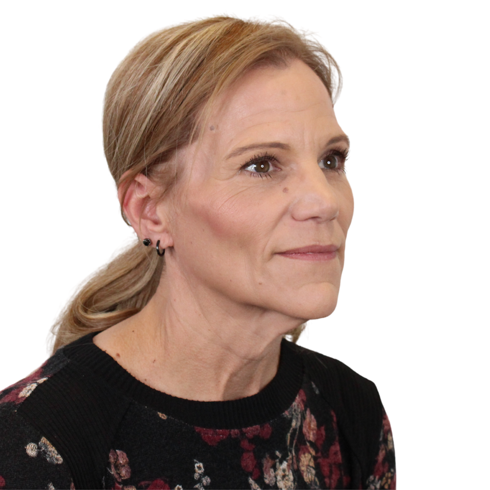 Deep Plane Facelift Before & After Gallery - Patient 131086 - Image 3